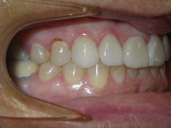 Cosmetic Changes with Veneers and Crown and Bridge: Case 2 - After