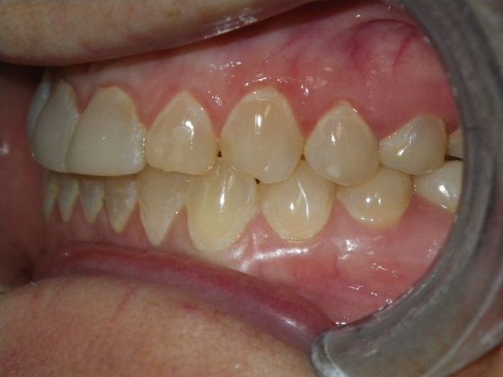 Cosmetic Changes with Veneers and Crown and Bridge: Case 2 - Before