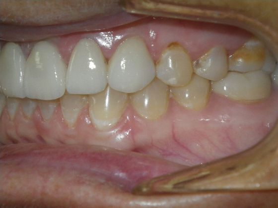 Cosmetic Changes with Veneers and Crown and Bridge: Case 2 - After