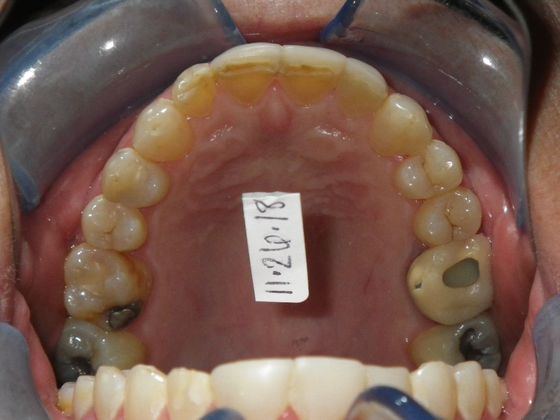 Cosmetic Changes with Veneers and Crown and Bridge: Case 2 - Before