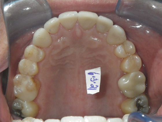 Cosmetic Changes with Veneers and Crown and Bridge: Case 2 - After