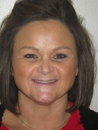 Cosmetic Changes with Veneers and Crown and Bridge: Case 2 - Before