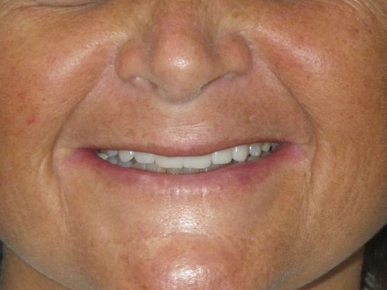 Cosmetic Changes with Veneers and Crown and Bridge: Case 2 - After