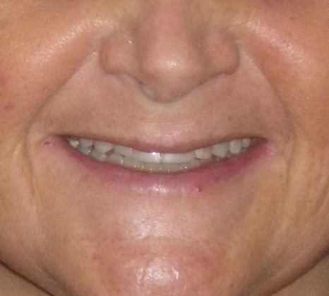 Cosmetic Changes with Veneers and Crown and Bridge: Case 2 - Before
