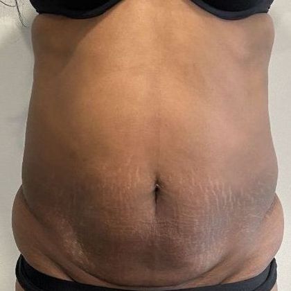 Liposuction Case 15 Liposuction Naugatuck, CT - Before