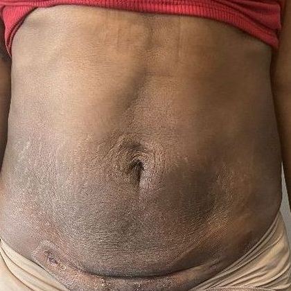 Liposuction Case 15 Liposuction Naugatuck, CT - After