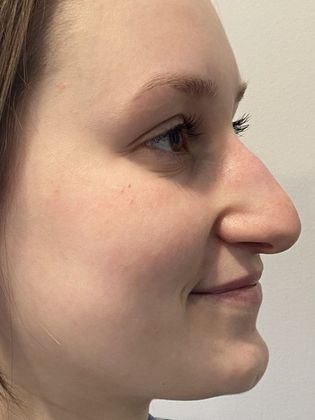 Rhinoplasty: Case 27 Rhinoplasty Guilford, CT - Before
