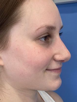 Rhinoplasty: Case 27 Rhinoplasty Guilford, CT - After