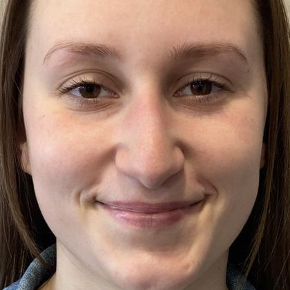 Rhinoplasty: Case 27 Rhinoplasty Guilford, CT - Before