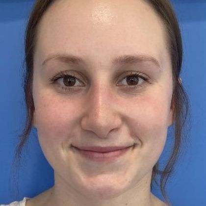 Rhinoplasty: Case 27 Rhinoplasty Guilford, CT - After