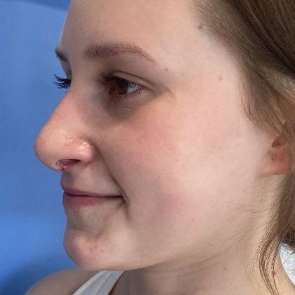 Rhinoplasty: Case 27 Rhinoplasty Guilford, CT - After