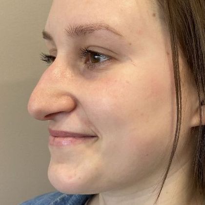 Rhinoplasty: Case 27 Rhinoplasty Guilford, CT - Before