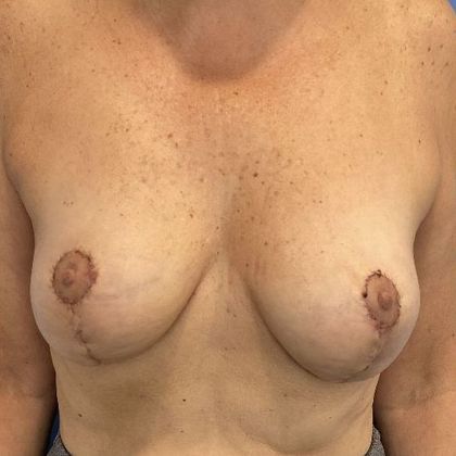 Breast Lift: Case 11 Breast Lift, New Milford - After