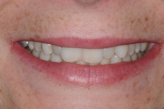 Smile Makeover Album Case 9 - Before