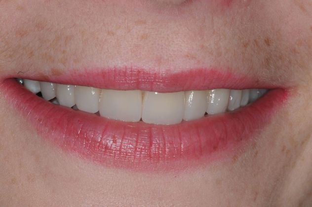 Smile Makeover Album Case 9 - After