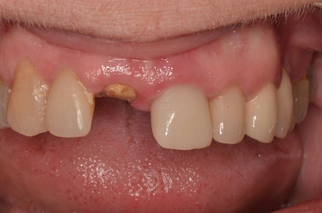 Dental Implants Case 47 - Before