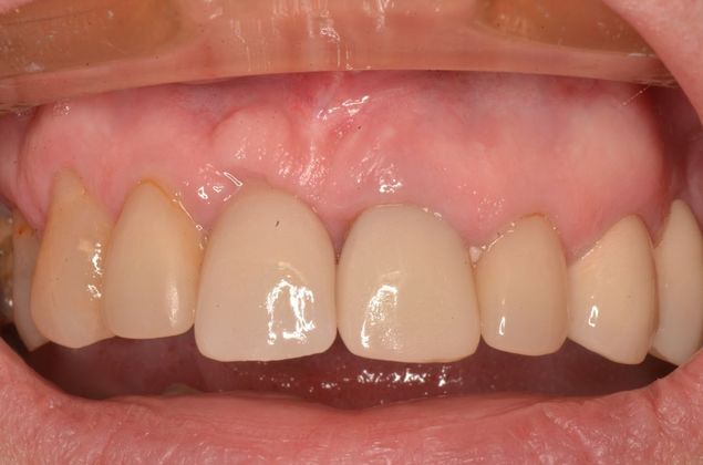 Dental Implants Case 47 - After