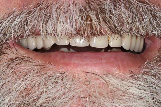 Dentures: Case 5 - Before