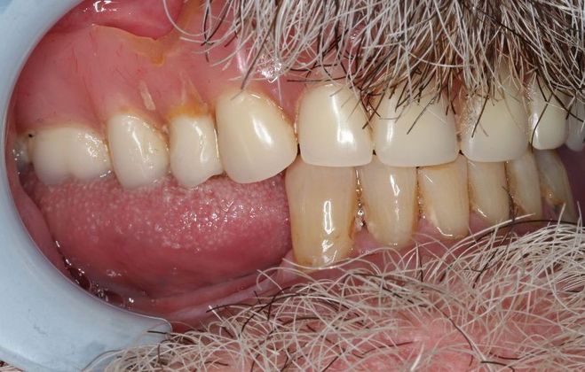 Dentures: Case 5 - Before