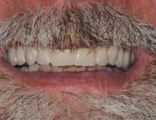 Dentures Case 5 - After