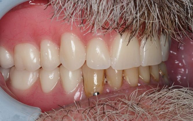 Dentures: Case 5 - After