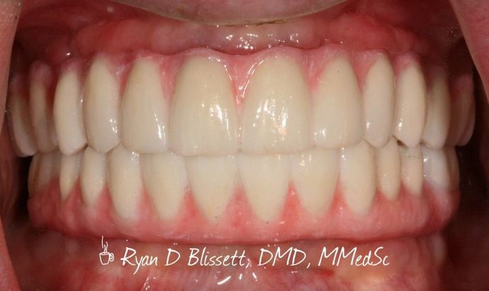 All-on-4 / All-on-X: Case 19 - After