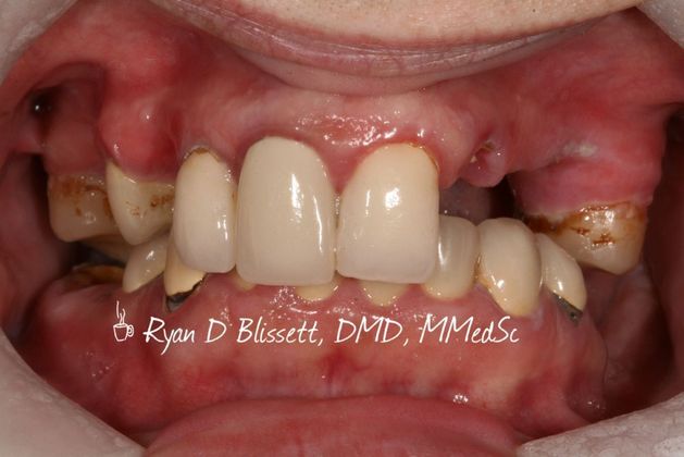 All-on-4 / All-on-X: Case 19 - Before