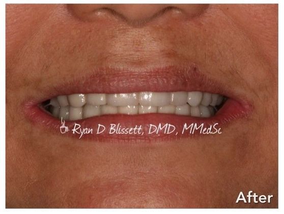 All-on-4 / All-on-X: Case 21. - After