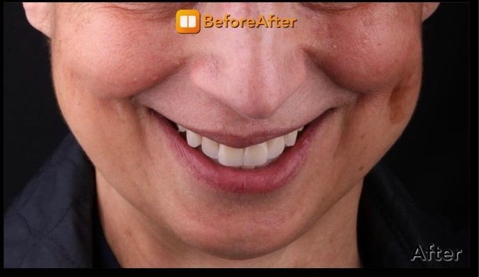 All-on-4 / All-on-X: Case 17 - After