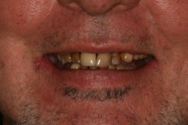 All-on-4 / All-on-X: Case 20 - Before