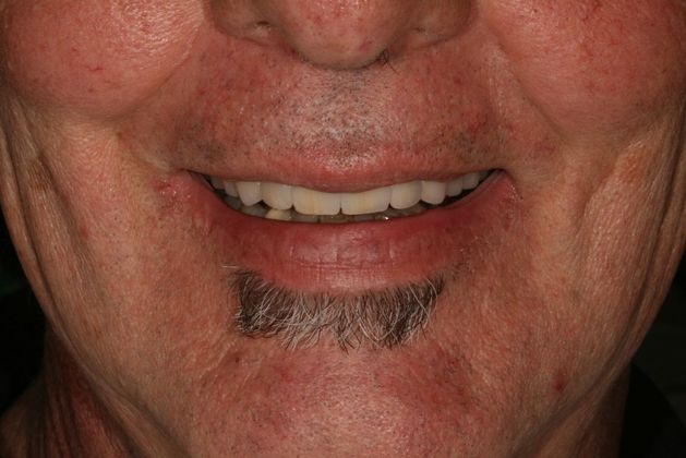 All-on-4 / All-on-X: Case 20 - After