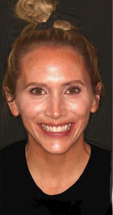 Porcelain Veneers Case 12 - Before