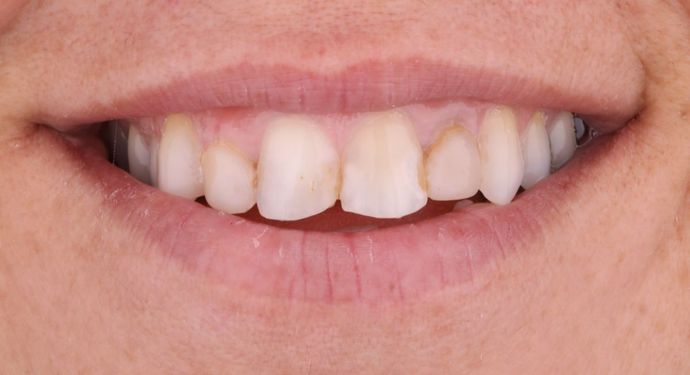 Porcelain Veneers Case 4 - Before
