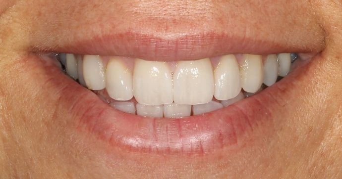 Porcelain Veneers Case 4 - After