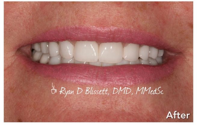 Porcelain Veneers: Case 5 - After