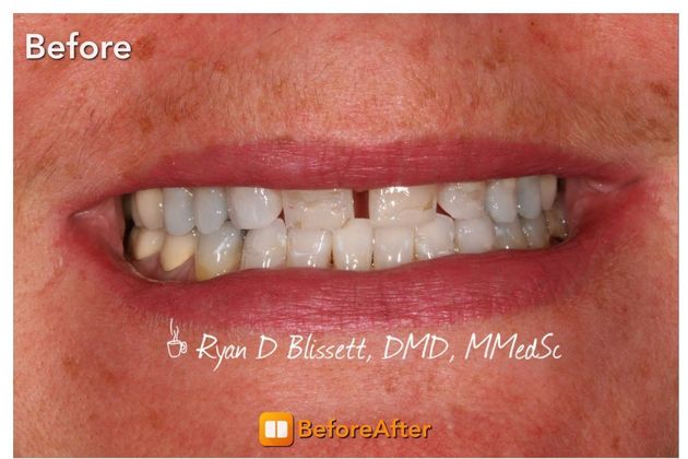 Porcelain Veneers: Case 5 - Before