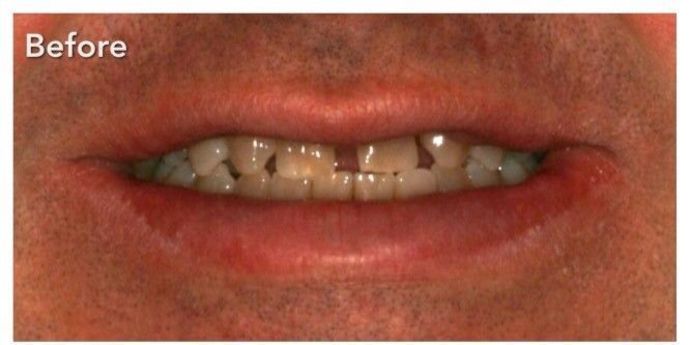 Porcelain Veneers Case 6 - Before