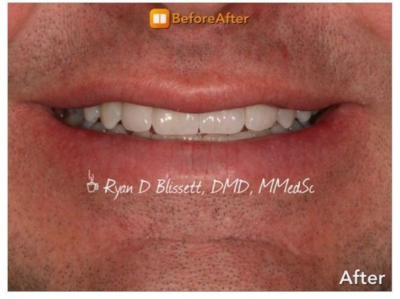 Porcelain Veneers Case 6 - After