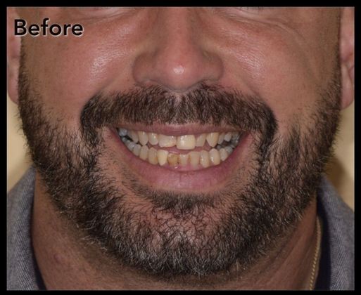 Porcelain Veneers Case 7 - Before