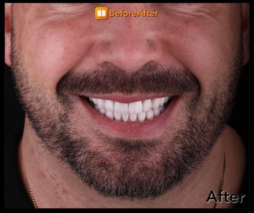 Porcelain Veneers Case 7 - After