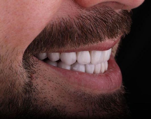 Porcelain Veneers: Case 7 - Before