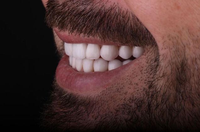 Porcelain Veneers: Case 7 - After