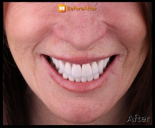 Porcelain Crowns Case 6 - After