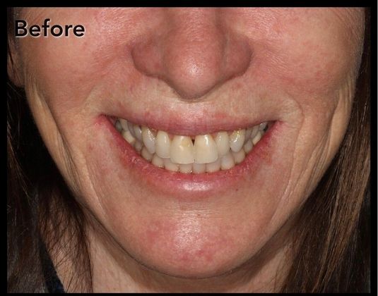 Porcelain Crowns Case 6 - Before