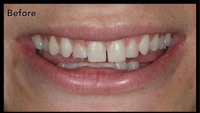 Porcelain Crowns Case 7 - Before