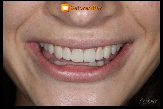 Porcelain Crowns Case 7 - After