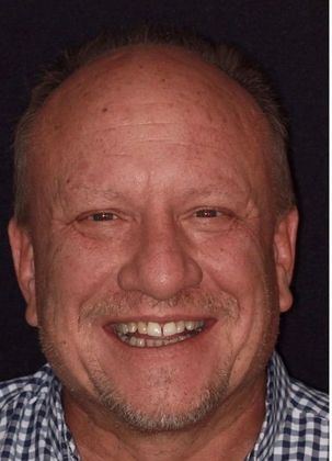 Porcelain Crowns Case 8 - Before