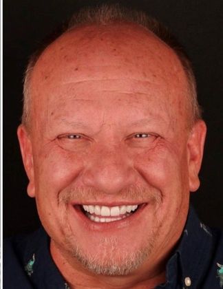 Porcelain Crowns Case 8 - After