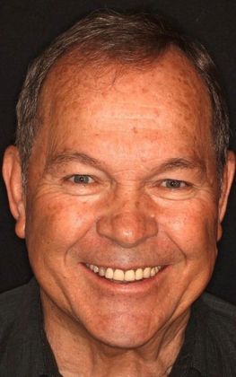 Porcelain Crowns Case 9 - Before