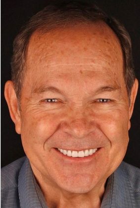 Porcelain Crowns Case 9 - After